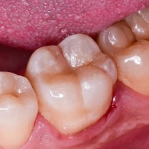 Amalgam Replacement After