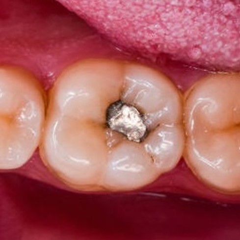 Amalgam Replacement After