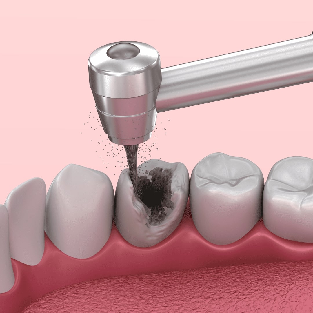 Amalgam Replacement