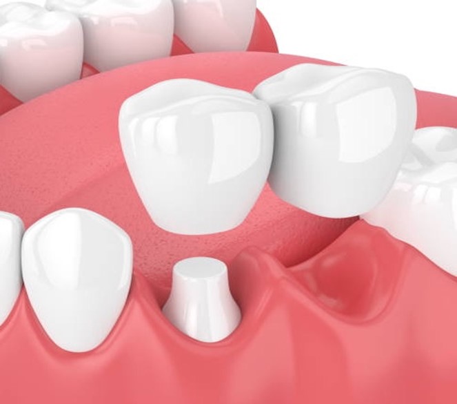 Dental Bridges Near You