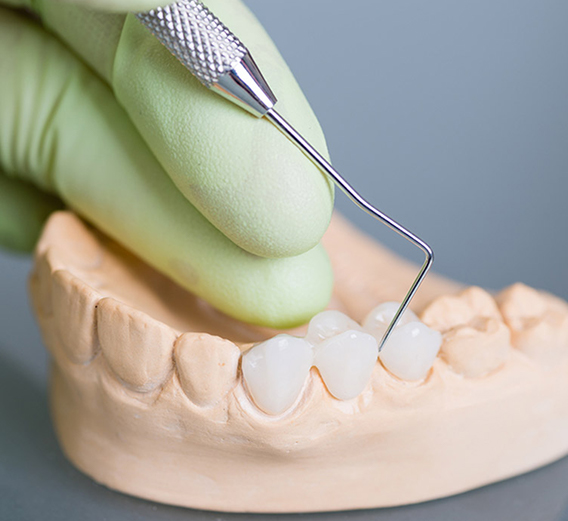 Dental Crowns