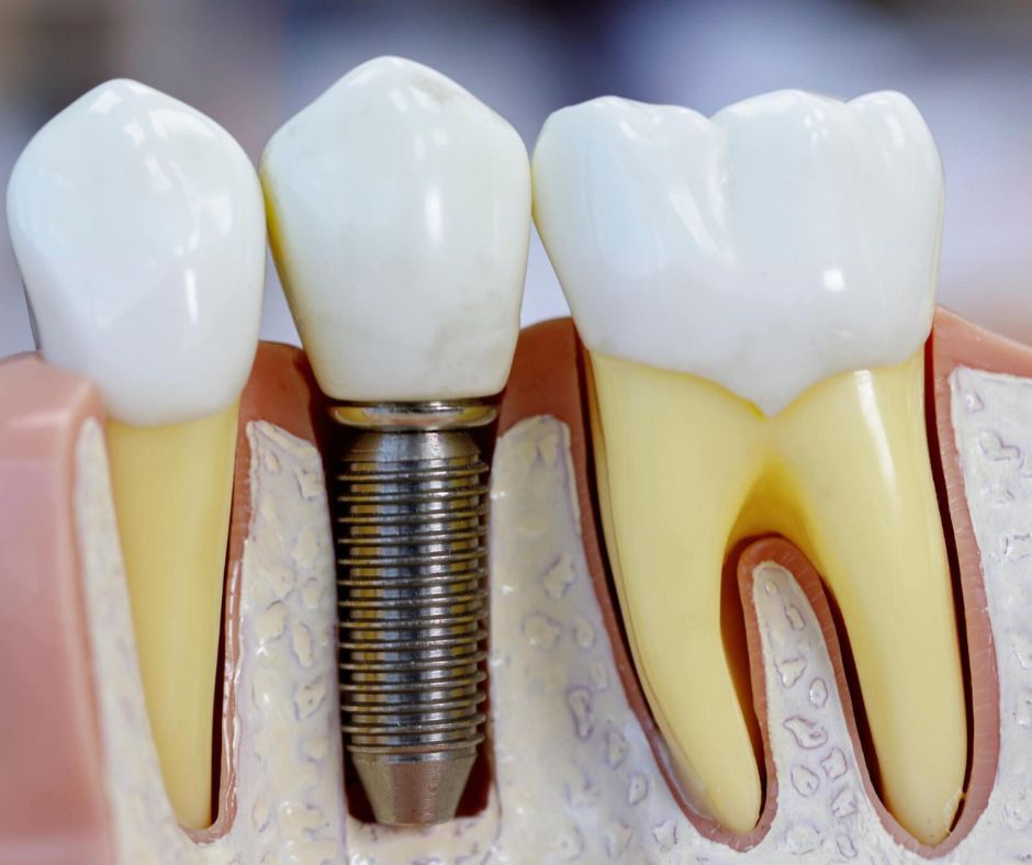 Dental Implants in Grande Prairie
