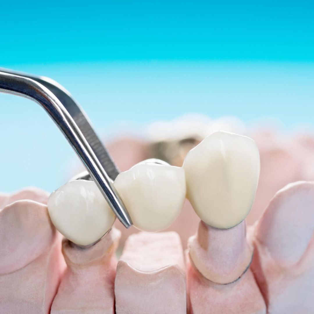 How Long Dental Crowns Last