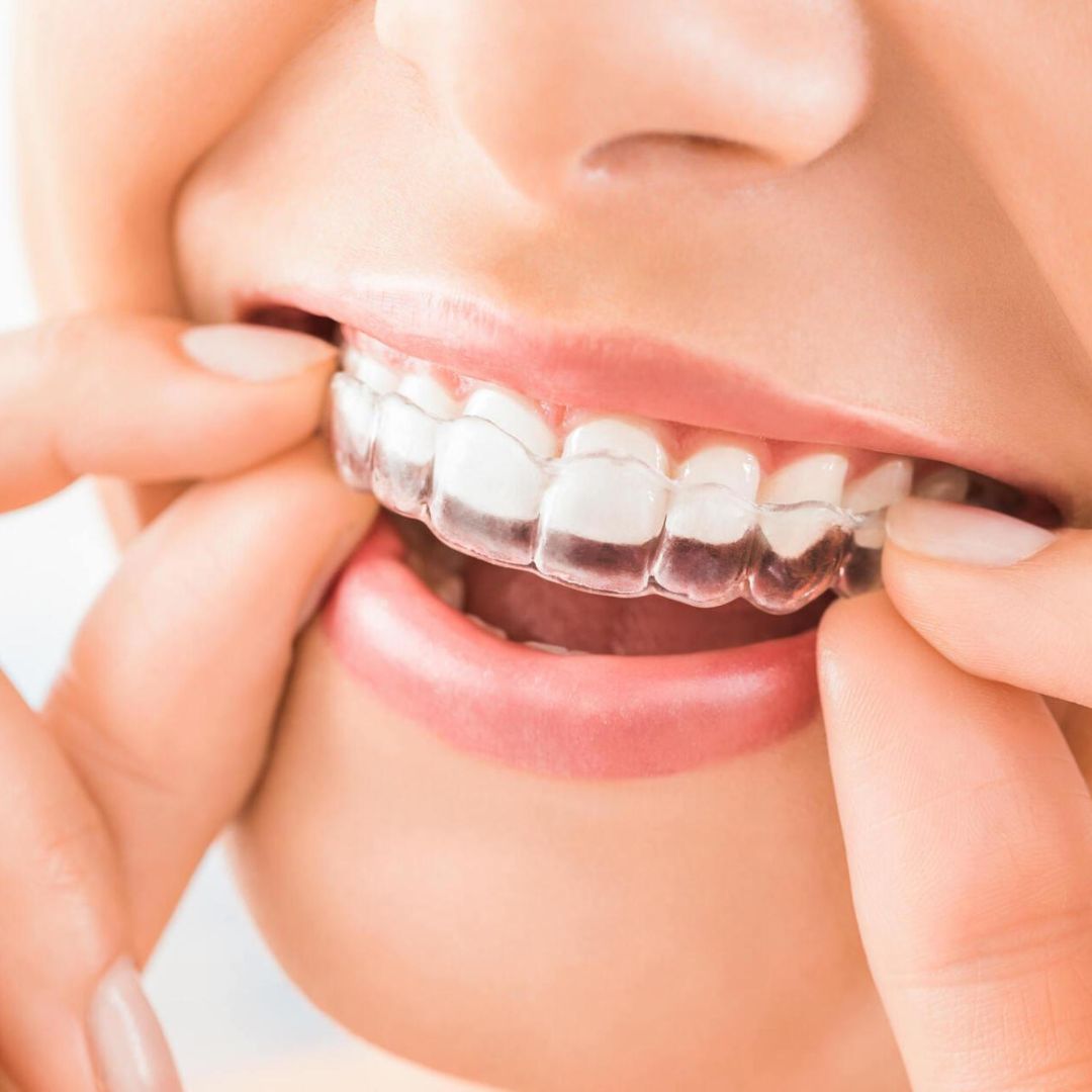 Invisalign in Grande Prairie