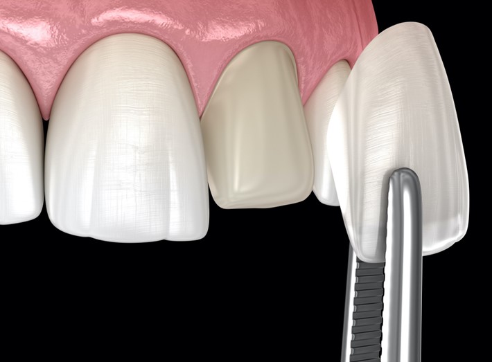 Porcelain Veneers Near You