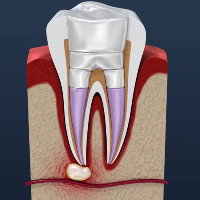 Root Canal Treatment Near You