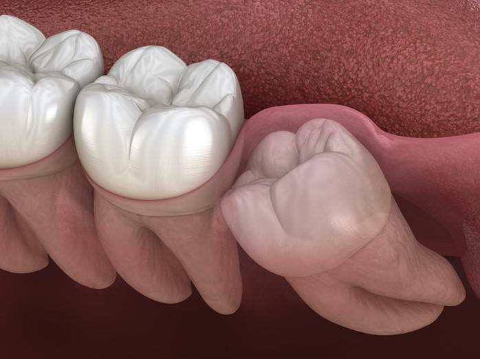 Wisdom Tooth Removal in Grande Prairie