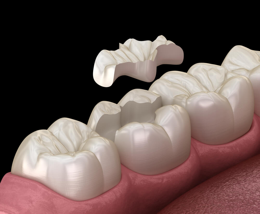 Your Tooth Filling Falls Out: What to Do and NOT Do